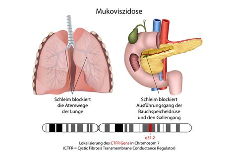 Nur wenn die diagnose frühzeitig gestellt wird, besteht für betroffene die chance über das kindesalter hinaus zu überleben. Mukoviszidose - Was ist das? Cystische Fibrose - Inhalation.de