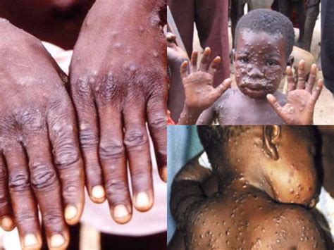 Though milder than smallpox, monkeypox can be fatal. New Cases Of Monkey Pox Recorded In Benue, Edo