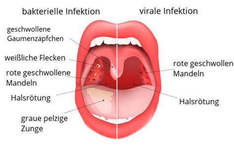 Lesen sie alles über symptome und behandlung der krankheit! Mandelentzündung Wie Lange Zuhause Bleiben