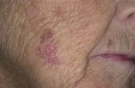 Nonmelanoma skin cancer are more common such as squamous cell carcinoma and basal cell carcinoma. Facial Skin Cancer Pictures - 33 Photos & Images ...