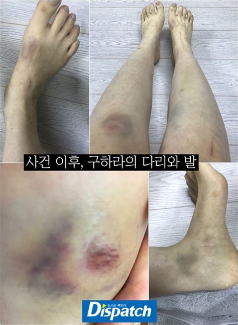 And now cctv footage has a man (reportedly her now ex boyfriend) follows into the same elevator and also checks his neck in the same mirror. Koo Hara Reveals Traumatic Photos Of The Injuries From Her ...
