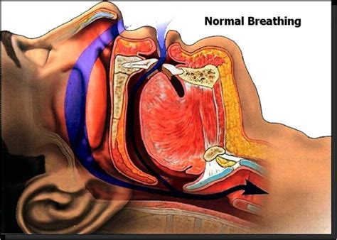 Apnea is repetitive episodes of cessation of breathing during sleep. Sleep Apnea Dentst | Glendale Specialist Dentist