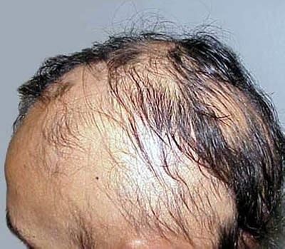 Similarly, men whose hair loss may be the result of autoimmune issues like lichen planopilaris or alopecia areata should undergo blood tests to check for tsh (thyroid), total blood count (tbc), iron (ferritin), b12, esr and ana. Alopecia Areata