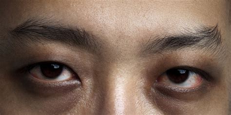 Kerutan di bawah mata merupakan tanda penuaan yang umum ditemukan. Lingkaran gelap di mata ternyata disebabkan oleh 5 makanan ...