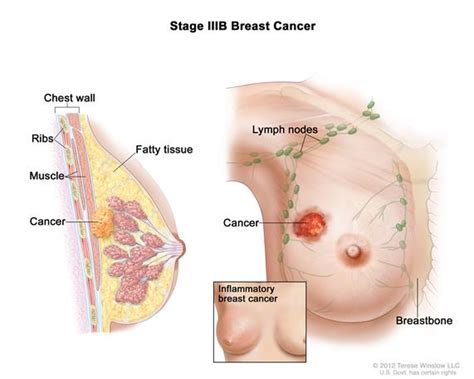 What does breast cancer look like on a mammogram? Definition of stage IIIB breast cancer - NCI Dictionary of ...