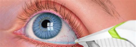 However, their increased sensitivity can mean that what might only be a minor injury on another part of your body could be much more traumatic if your eyes are affected. Emergency Eye Care - North Raleigh Family Eye Care