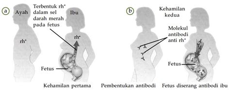 Eritroblastosis fetalis umumnya disebabkan terjadinya isoimunisasi, yaitu proses pembentukan antibodi terhadap antigen individu lain yang berbeda. BIOLOGI SMA: C. Golongan Darah dan Transfusi Darah