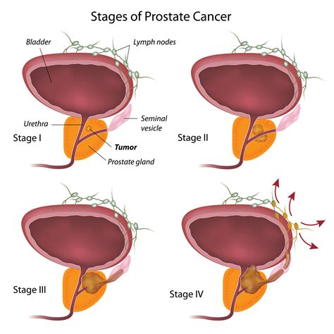 Moving through the walls of nearby lymph nodes or blood vessels; Prostate Cancer Stages - University Health News