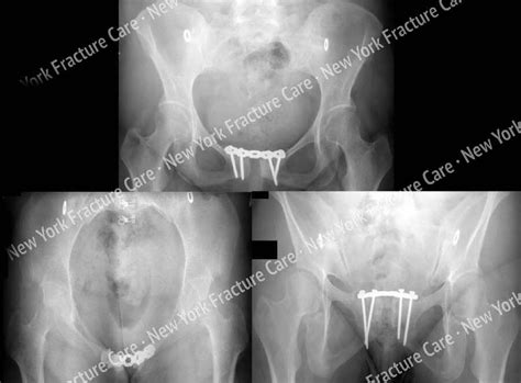 Chronic pelvic pain following childbirth - New York ...