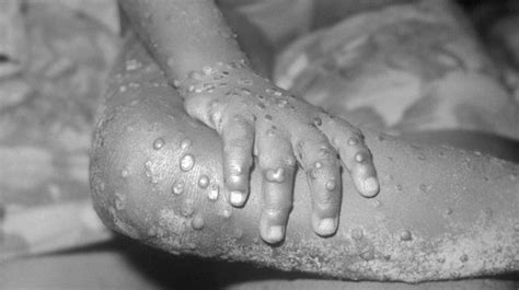 Monkeypox virus is mostly transmitted to people from wild animals such as rodents and primates, but. Healthcare worker in Blackpool confirmed as the UK's third ...