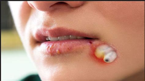 Given the black color many believe these spots are clogged with dirt, but really it's the exposure to air that oxidizes the clogged pore and turns it black. Dr pimple popper Best Doctor Remove Cyst Blackheads Fast ...