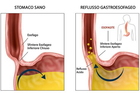 La diagnosi di esofagite si fa mediante la raccolta della storia. Esofagite | Cause e Sintomi | Cure, Dieta, Rimedi