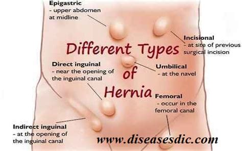 You may have any of the following: Hernia - Causes, Treatment, and Prevention.