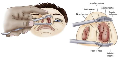 Posterosuperiorly, the bony nasal septum is composed of the perpendicular plate of the ethmoid. Ear, Nose, Throat, and Mouth | Musculoskeletal Key