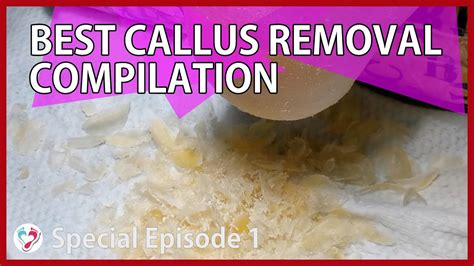 Lifting heavy weights in the gym also can cause hand calluses. Best Callus Removal Compilation - YouTube