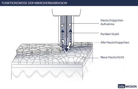 What is the best home microdermabrasion machine for you? Microdermabrasion - Infos, Kosten, Ärzte | info Medizin