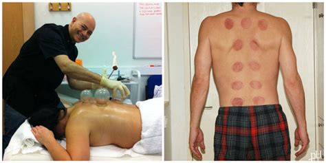 Comparison of hmo and health insurance in the philippines. The benefits of cupping therapy: Is it worth the crazy circles on your back?