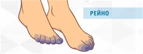 Рейно болезнь диета Лечение болезни и синдрома Рейно в Санкт-Петербурге Лечение болезни и синдрома Рейно в Санкт-Петербурге Рейно болезнь диета