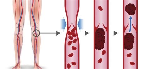 Resistência à proteína c ativada. Trombose venosa profunda: fique atento e saiba reconhecer ...