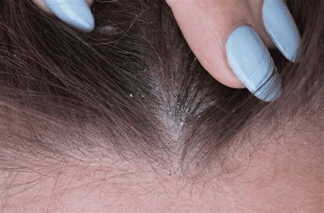 Head lice, caused by the parasite, pediculus humanus capitis, is a condition that causes intense itching of the scalp and predominantly presents in skin infection: What Causes Dandruff & How to Treat it at Home?