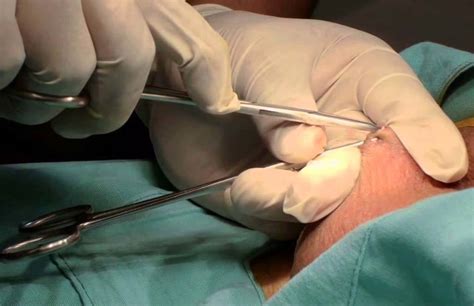Es una cirugía ambulatoria con bajo riesgo de complicaciones o efectos secundarios. Mitos e Verdades sobre a Vasectomia | Urologista em São Paulo