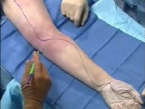 Compartment syndrome of the forearm: Forearm fasciotomy approach/incision/ in compartment ...