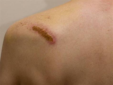 To get rid of scabs more quickly, you have to know the way to properly clean your scab, and how to deal correctly with infections. How to Get Rid of a Scab?