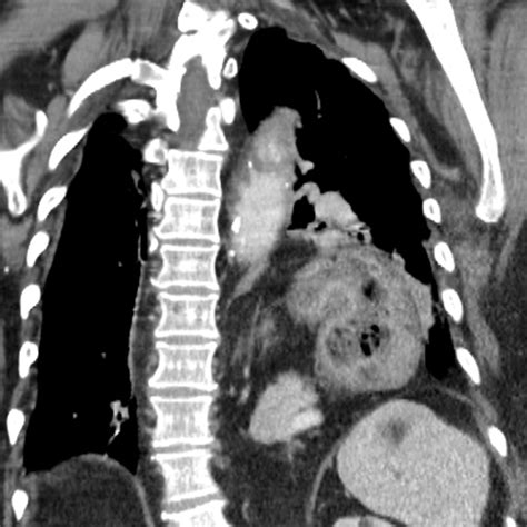 A congenital diaphragmatic eventration occurs when partial or complete abnormal displacement or elevation of a generally intact diaphragm takes place into chest cavity. Diaphragmatic hernia, chronic gastric valvulus and aortic ...