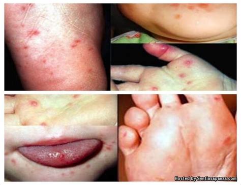 Penyakit tangan kaki dan mulut hfmd. Penyakit Tangan, Kaki Dan Mulut, Simptom, Pencegahan Serta ...