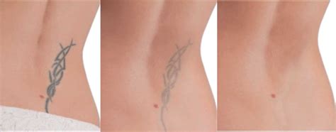 Tattoo removal without laser usage is a complicated process that should only be performed by trusted professionals to avoid severe skin damage. Tattoo Removal — Ageless Skin & Laser Clinic