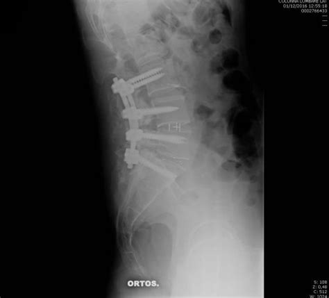 Colonna Vertebrale - Dott Andrea Barbanera