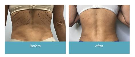 Peredo suggested a second session to achieve peak results. Before and After Skin Treatment Northridge, Simi Valley