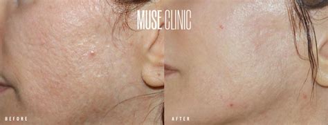 To get that glow, many consumers now turn to something called microneedling, which is offered in many. Microneedling - MUSE Clinic