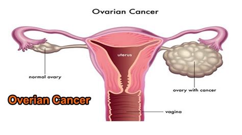 Premenopausal women who have both ovaries removed as treatment for ovarian cancer are likely to enter the menopause soon after surgery. 5 signs that can help in early diagnosis of ovarian cancer ...