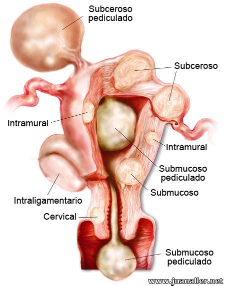 I fibromi uterini sono escrescenze non cancerose dell'utero che spesso compaiono negli anni della fertilità. Fotografia miomas uterinos - Imagui