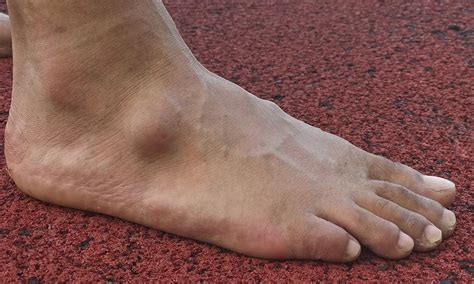 Pictures of ganglion cyst foot: That bump on your foot could be a ganglion cyst says ...