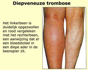 Trombose is de afsluiting van een ader of slagader door een bloedprop (trombus). Trombose