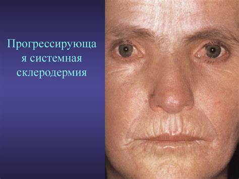 Диета системная красная волчанка Системная Красная Волчанка Фото Системная Красная Волчанка Фото Диета системная красная волчанка