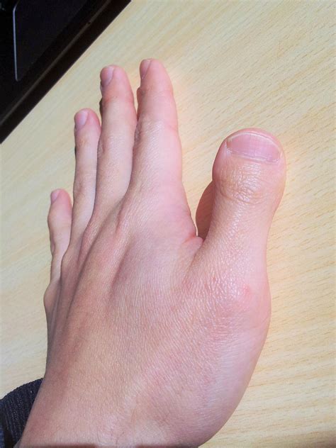 親指 - 春日部市、バスケ好きの1人で整体院やってる柔道整復師 ...