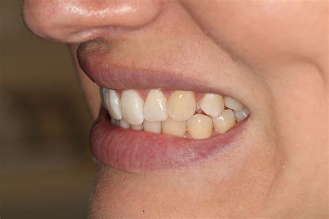 Composite Bonding - Ivory Dental Practice Ruislip