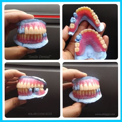Apakah gigi palsu anda telah rusak, atau menjadi longgar karena. Gigi Palsu | AHLI GIGI PALSU " SMILE DENTAL"