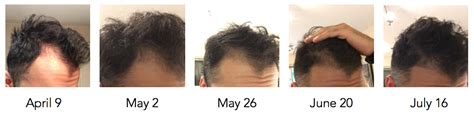 Natural ingredients based shampoo fortified with biotin, ketoconazole, niacin, copper tripeptides. Success WITH pics: saw results in 2 months. Variation of ...