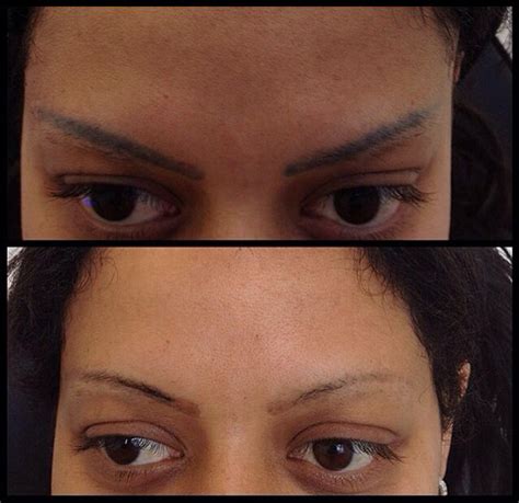 The process of electrolysis is a permanent hair removal solution that many men and women have employed nowadays. Laser Eyebrow Hair Removal | Permanent Eyebrow Removal