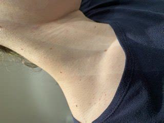 Acne collo e cuoio capelluto - Acne giovanile / tardiva ...
