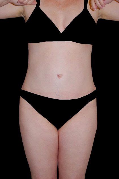 Tuckpointing is the rehabilitation or improvement of existing mortar joints in masonry walls. Best Tummy Tuck Pittsburgh, PA | Beleza Plastic Surgery ...