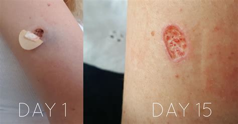 If you are still using a bandage on. Biopsy healing progress : Melanoma