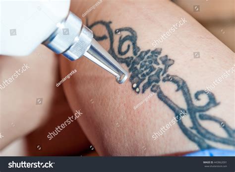 Tattoo removal market with a growing number of individuals experiencing tattoo regret, the tattoo removal market has also increased. Laser Tattoo Removal Leg Tattoo Stock Photo 443862091 ...