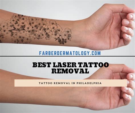 Punch debridement to remove a single lesion. Laser Tattoo Removal- Phildelphia & Main Line PA - farber ...