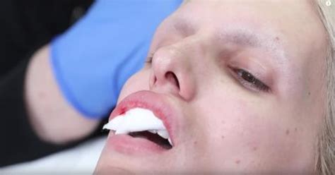 Kirby marked star's lips with a sharpie marker and then cut into each section with a scalpel. YouTuber Jeffree Star Had "Really Bad" Teeth: Before and After Pics