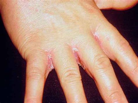 Apr 15, 2020 · intertrigo is a rash that usually affects the folds of the skin, where the skin rubs together or where it is often moist. Candidiasis Cutáneas - Intertrigo candidiásico